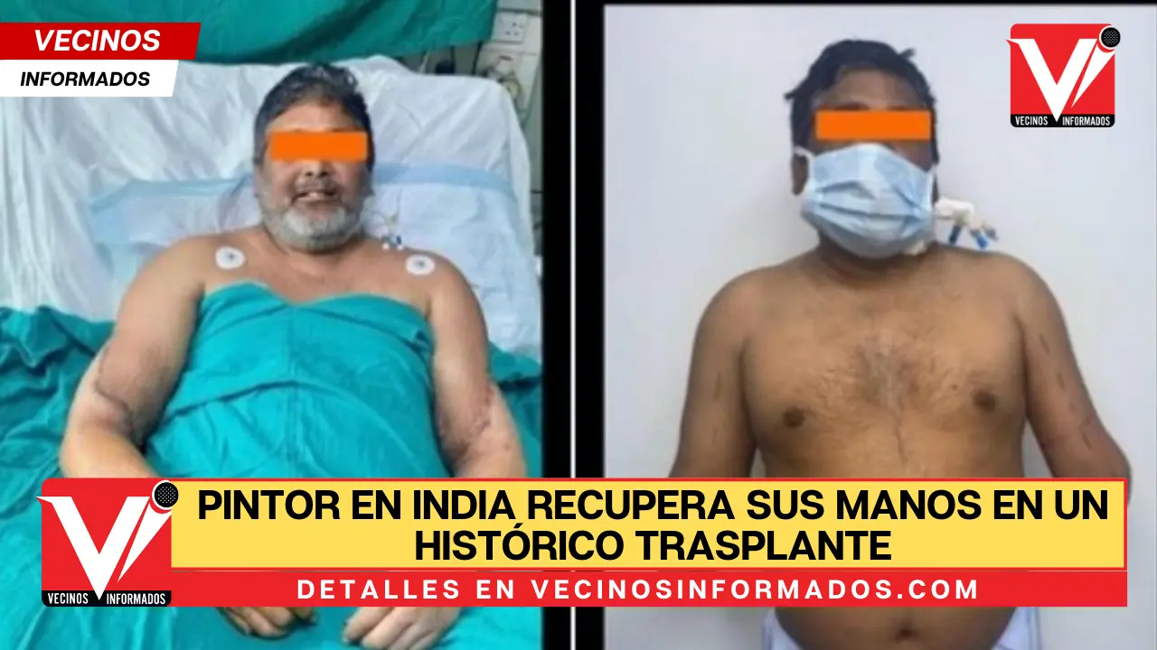 Pintor En India Recupera Sus Manos En Un Hist Rico Trasplante Donado